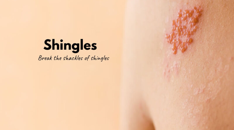 Shingles