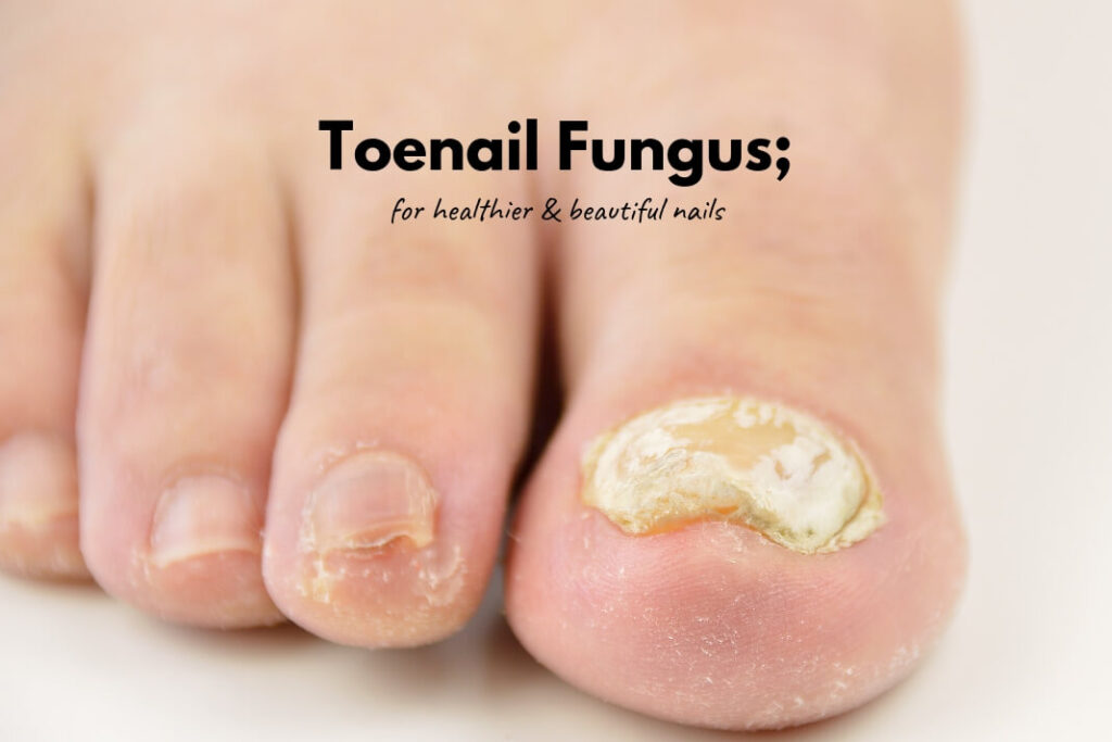 Toenail Fungus