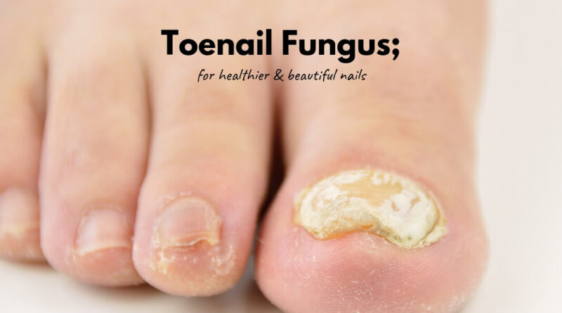 Toenail Fungus