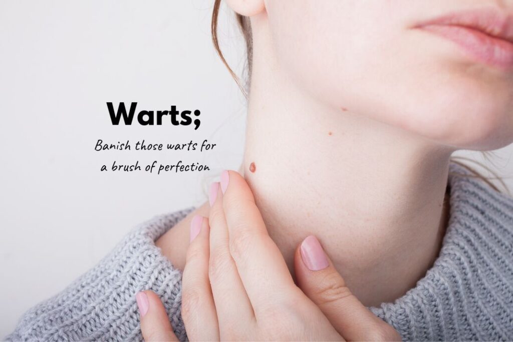 Warts