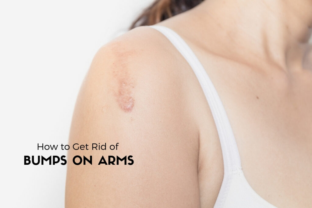 how to get rid of bumps on arms