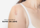 how to get rid of bumps on arms