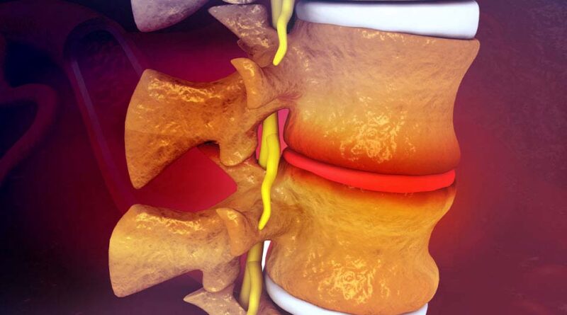 dorsal hernias or thoracic hernias