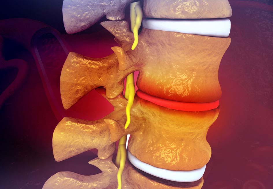 dorsal hernias or thoracic hernias